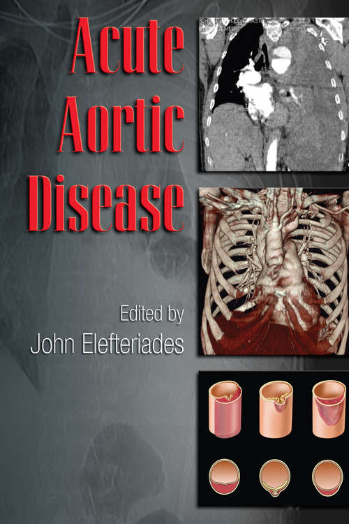 Book cover of Acute Aortic Disease (Fundamental and Clinical Cardiology)