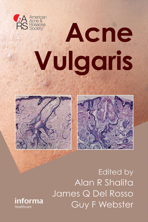 Book cover of Acne Vulgaris