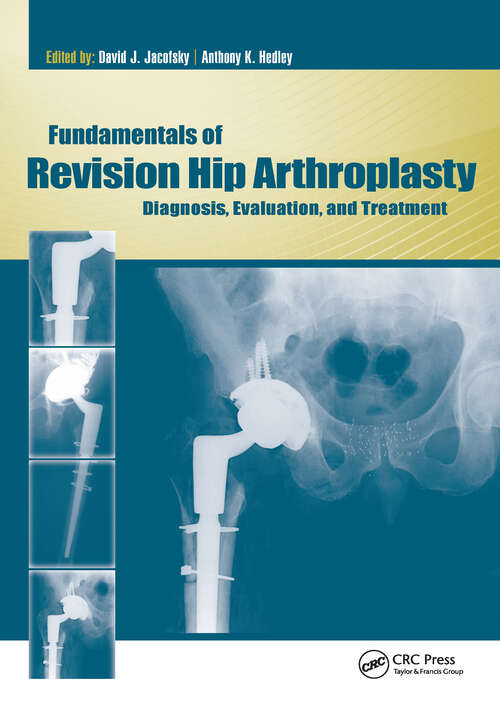 Book cover of Fundamentals of Revision Hip Arthroplasty: Diagnosis, Evaluation, and Treatment