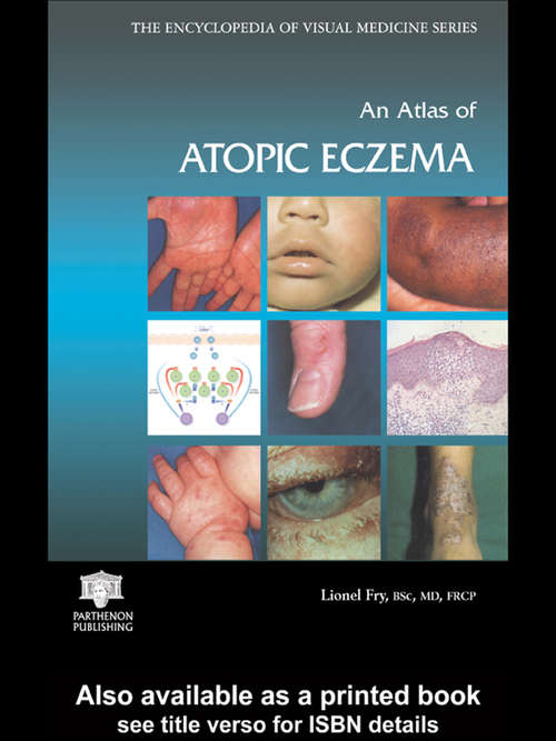 Book cover of An Atlas of Atopic Eczema