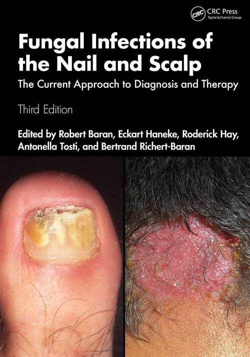 Book cover of Fungal Infections of the Nail and Scalp: The Current Approach to Diagnosis and Therapy