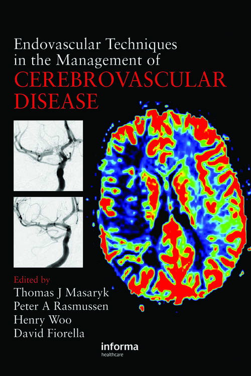 Book cover of Endovascular Techniques in the Management of Cerebrovascular Disease